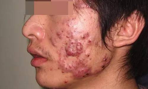 痤疮全面防治与护理步骤指南，初学者到进阶用户的必备指南